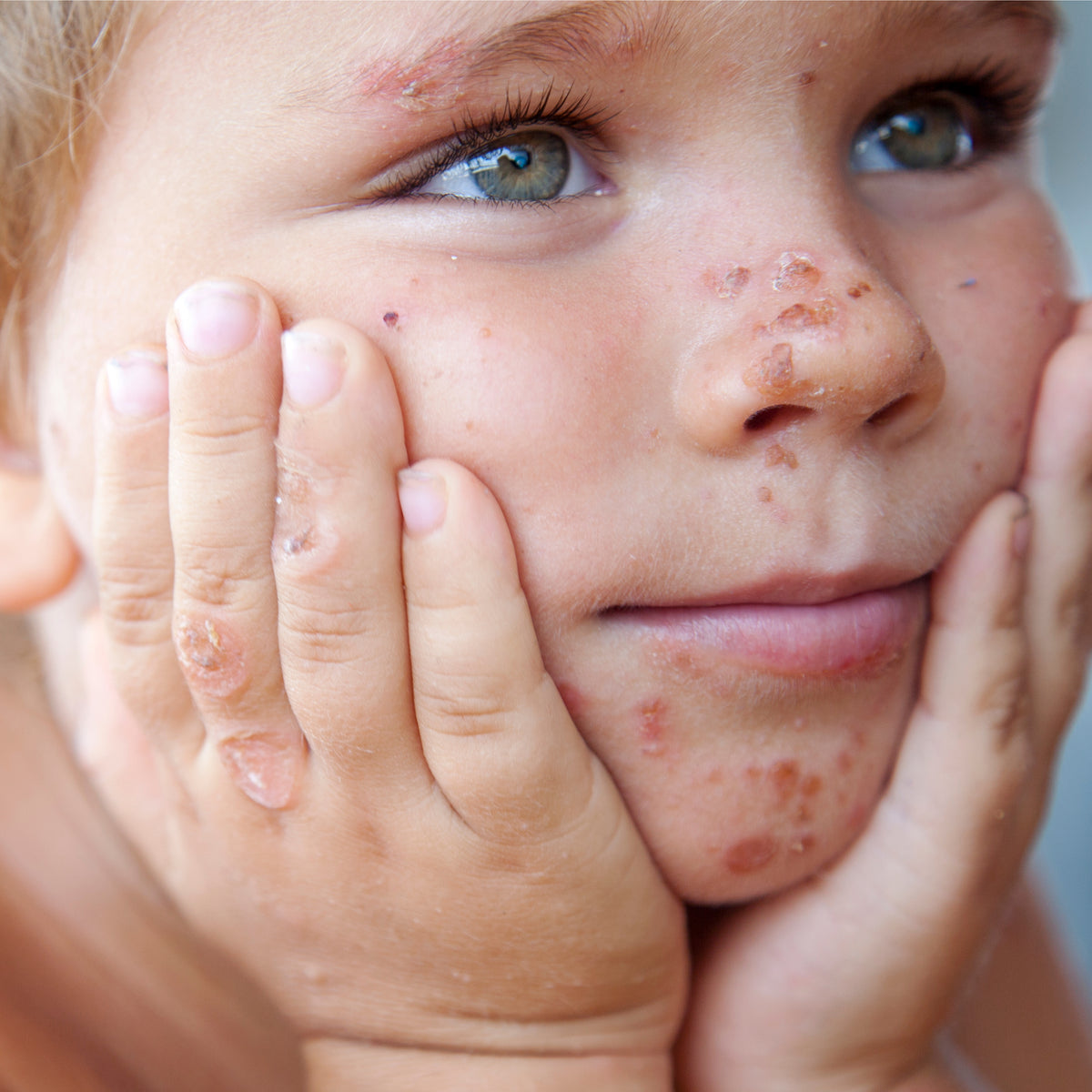 How to Help Your Child Get Through Psoriasis – Psolace